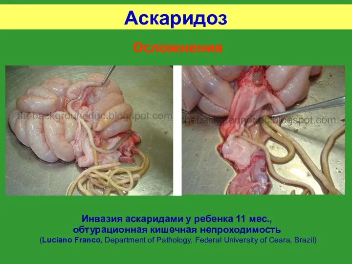 Аскаридоз Осложнения Инвазия аскаридами у ребенка 11 мес., обтурационная кишечная непроходимость