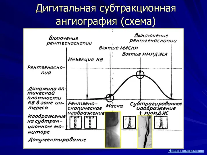 Дигитальная субтракционная ангиография (схема)