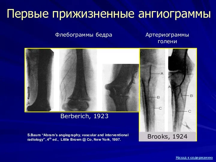 Первые прижизненные ангиограммы Флебограммы бедра Артериограммы голени