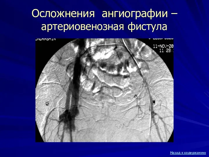 Осложнения ангиографии – артериовенозная фистула