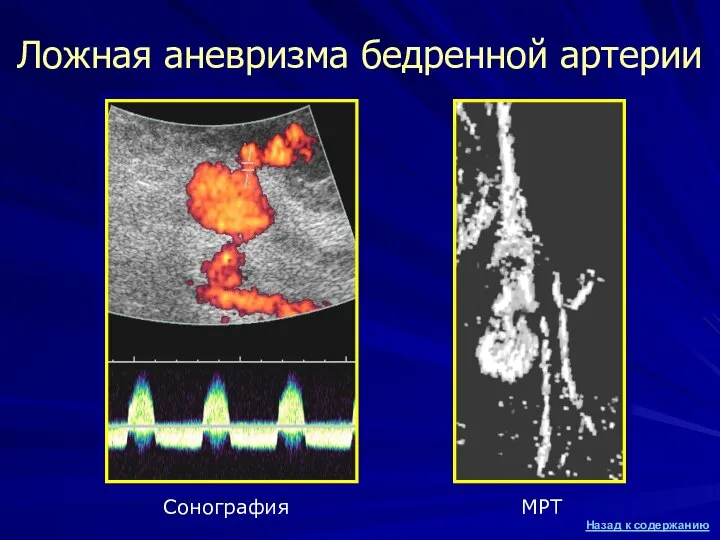 Ложная аневризма бедренной артерии Сонография МРТ