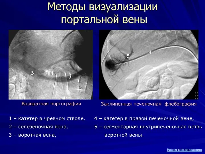 Методы визуализации портальной вены 1 – катетер в чревном стволе, 2