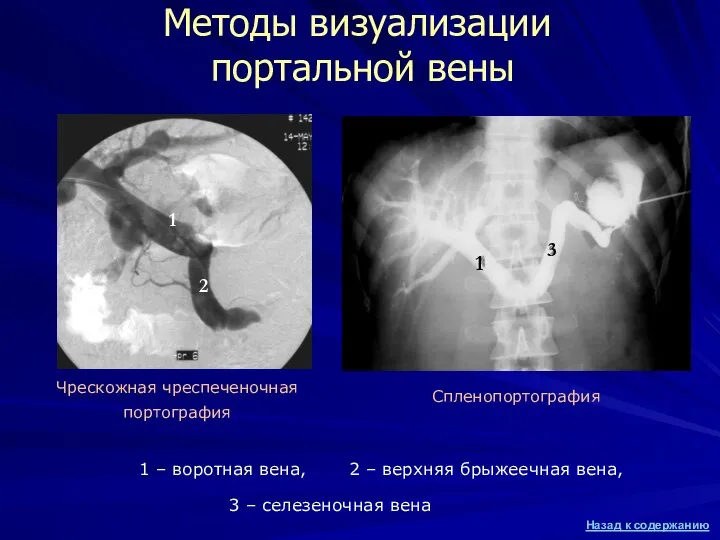 Методы визуализации портальной вены Спленопортография 2 1 3 1 1 –