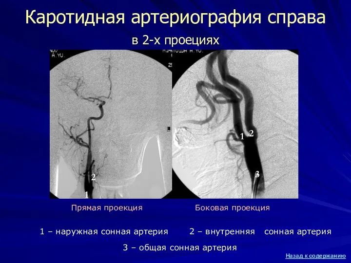 Каротидная артериография справа в 2-х проециях 1 – наружная сонная артерия