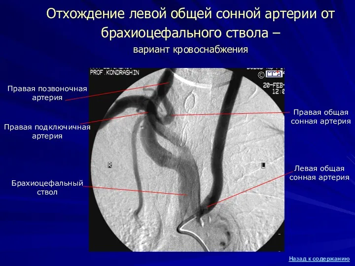 Отхождение левой общей сонной артерии от брахиоцефального ствола – вариант кровоснабжения