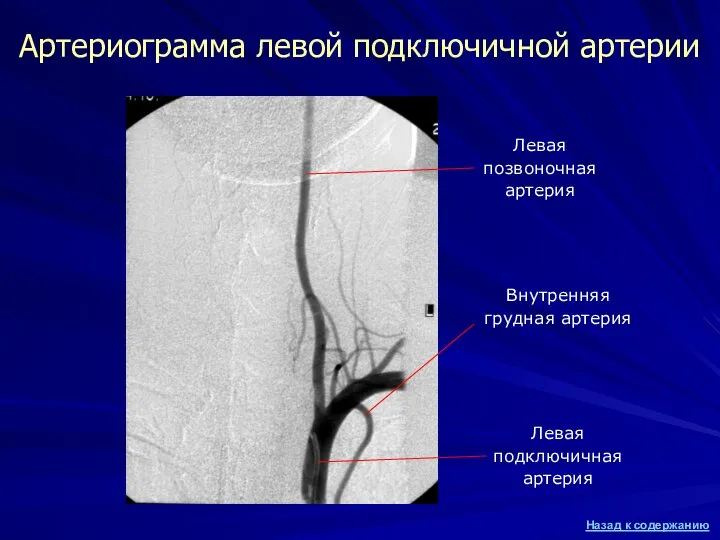 Артериограмма левой подключичной артерии Левая подключичная артерия Левая позвоночная артерия Внутренняя грудная артерия