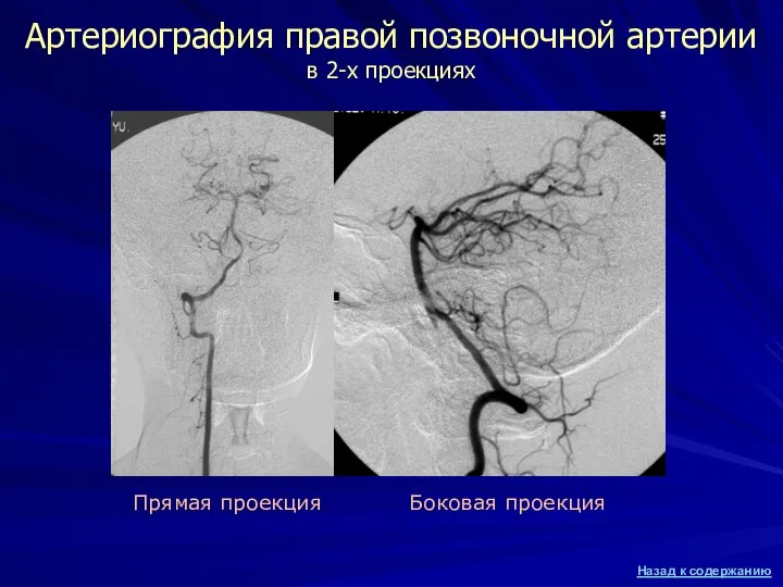 Артериография правой позвоночной артерии в 2-х проекциях Прямая проекция Боковая проекция