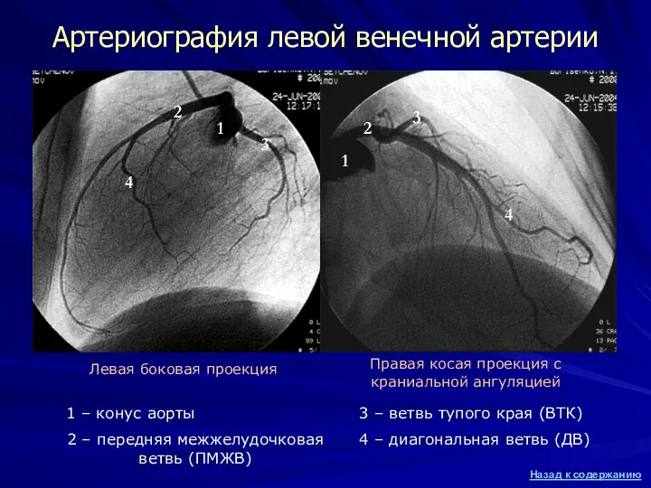 Артериография левой венечной артерии 1 – конус аорты 2 – передняя