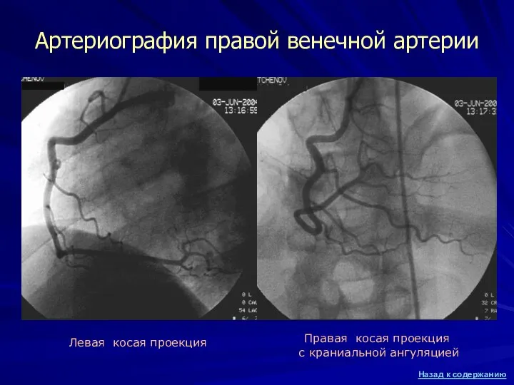 Артериография правой венечной артерии