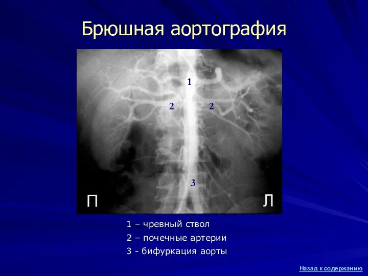 Брюшная аортография 1 2 2 3 1 – чревный ствол 2