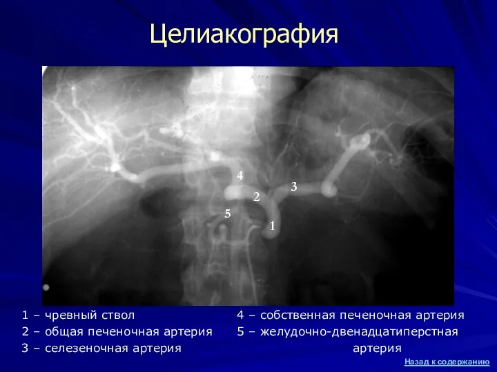Целиакография 1 – чревный ствол 2 – общая печеночная артерия 3