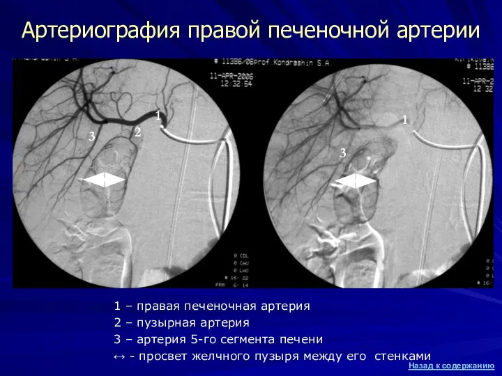 1 – правая печеночная артерия 2 – пузырная артерия 3 –