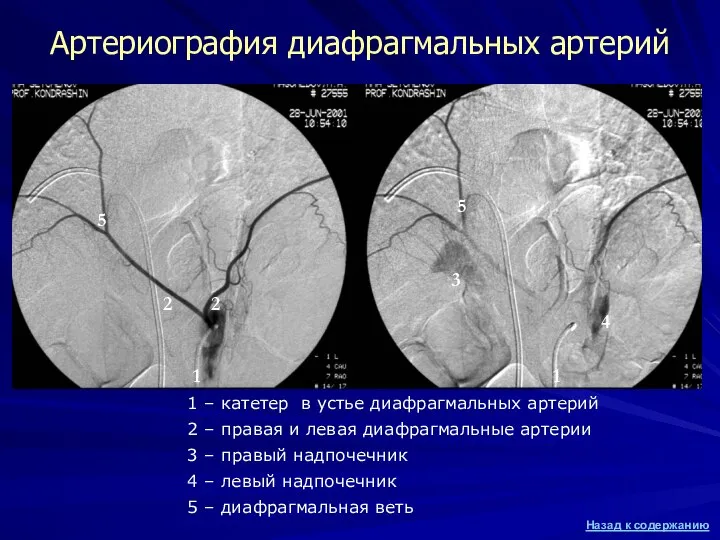 1 – катетер в устье диафрагмальных артерий 2 – правая и