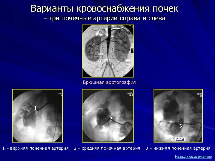 Варианты кровоснабжения почек – три почечные артерии справа и слева Брюшная