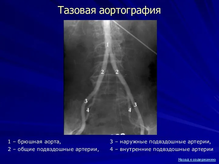 Тазовая аортография 3 – наружные подвздошные артерии, 4 – внутренние подвздошные