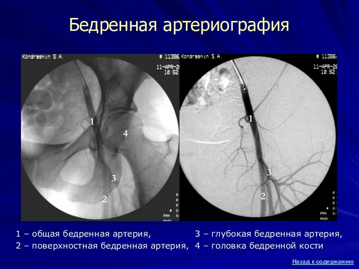 Бедренная артериография 1 – общая бедренная артерия, 2 – поверхностная бедренная