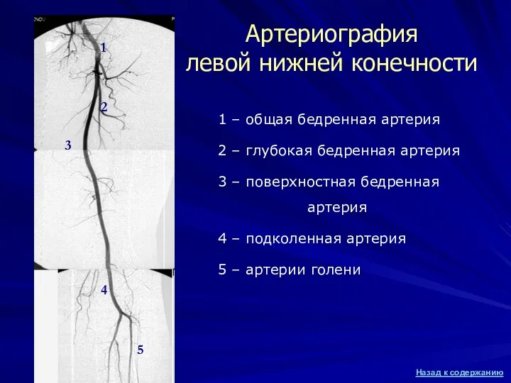 1 – общая бедренная артерия 2 – глубокая бедренная артерия 3