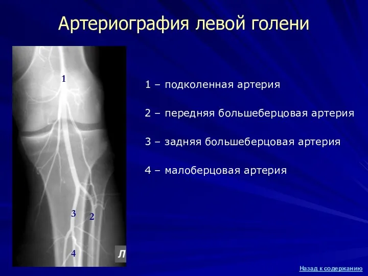 Артериография левой голени 1 – подколенная артерия 2 – передняя большеберцовая