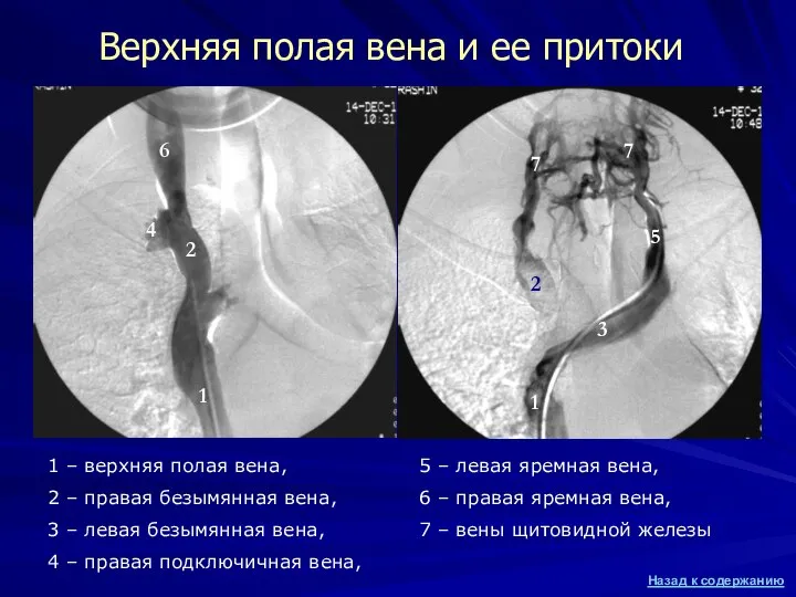 Верхняя полая вена и ее притоки 1 – верхняя полая вена,