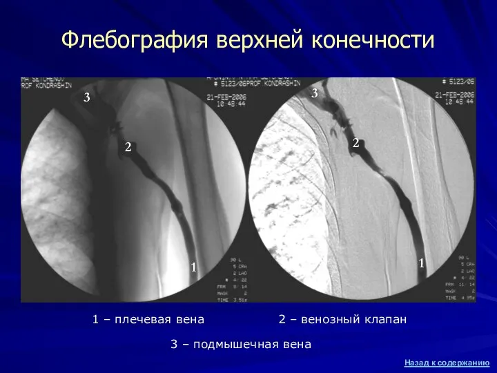 Флебография верхней конечности 1 – плечевая вена 2 – венозный клапан 3 – подмышечная вена