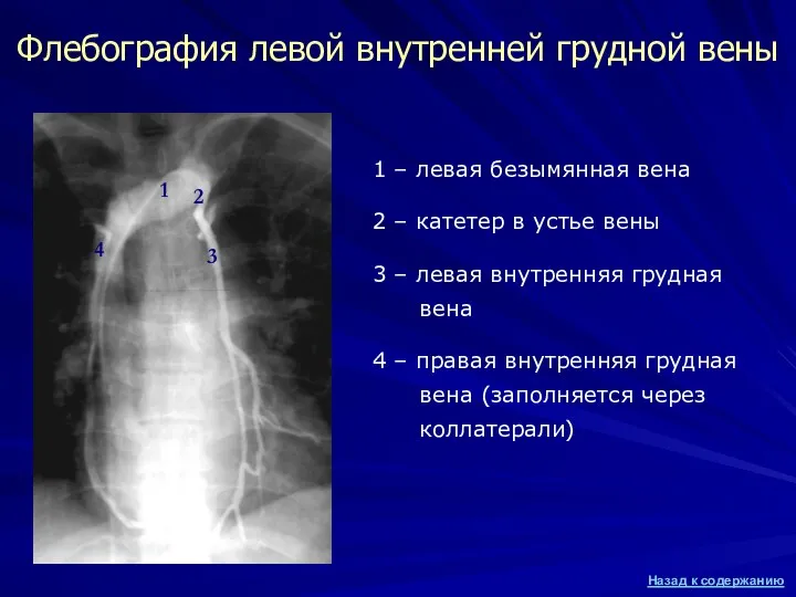 Флебография левой внутренней грудной вены 1 – левая безымянная вена 2