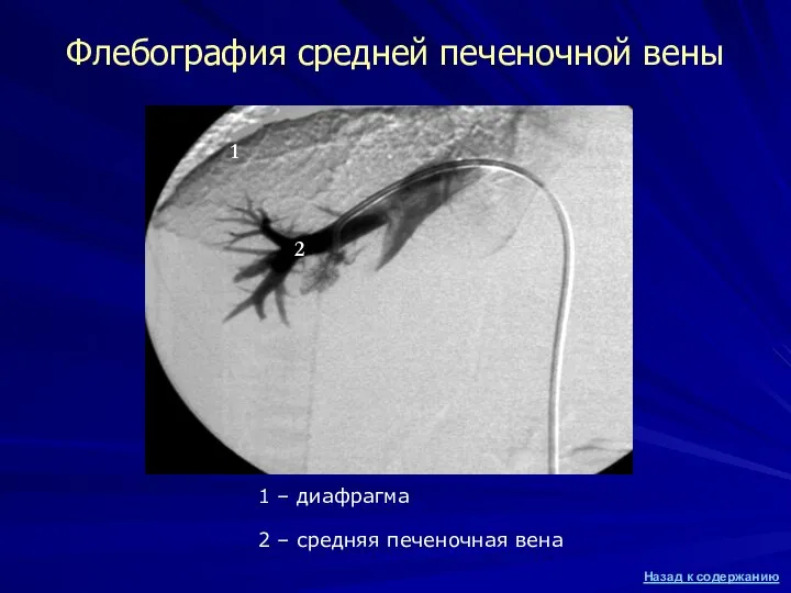 Флебография средней печеночной вены 1 – диафрагма 2 – средняя печеночная вена