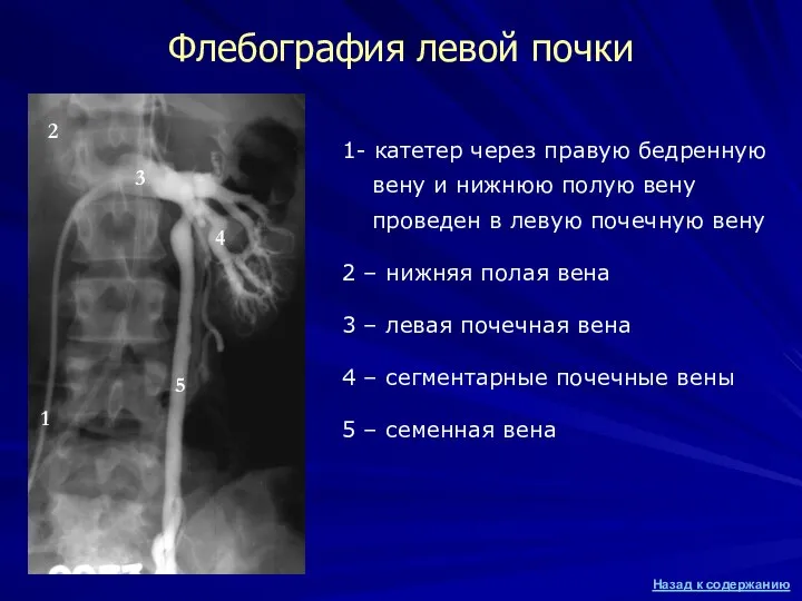 Флебография левой почки 1- катетер через правую бедренную вену и нижнюю