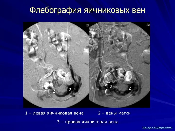 Флебография яичниковых вен 1 – левая яичниковая вена 1 3 –