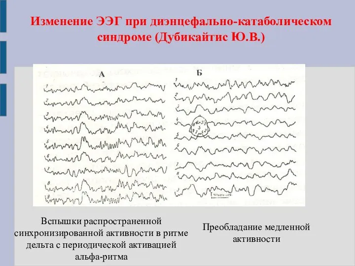 Изменение ЭЭГ при диэнцефально-катаболическом синдроме (Дубикайтис Ю.В.) Вспышки распространенной синхронизированной активности