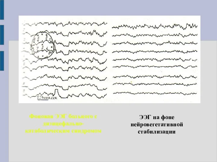 Фоновая ЭЭГ больного с диэнцефально-катаболическим синдромом ЭЭГ на фоне нейровегетативной стабилизации