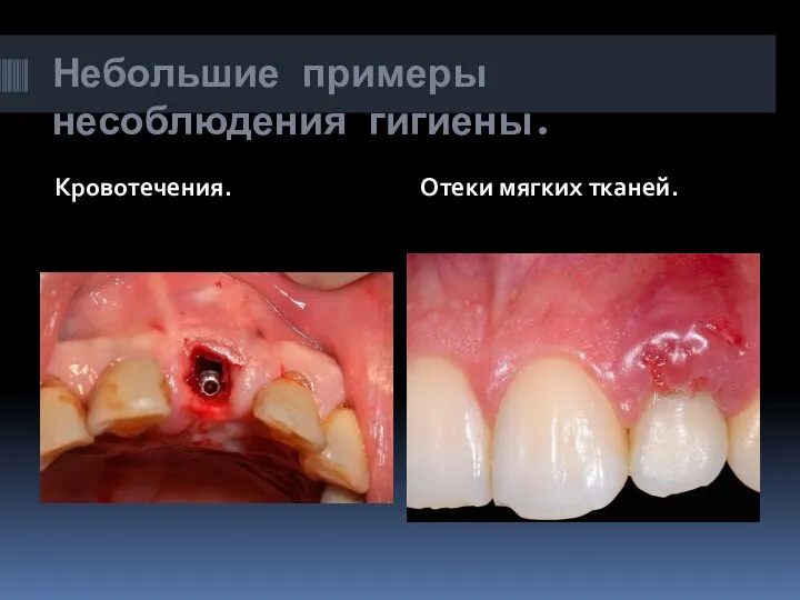 Небольшие примеры несоблюдения гигиены. Кровотечения. Отеки мягких тканей.