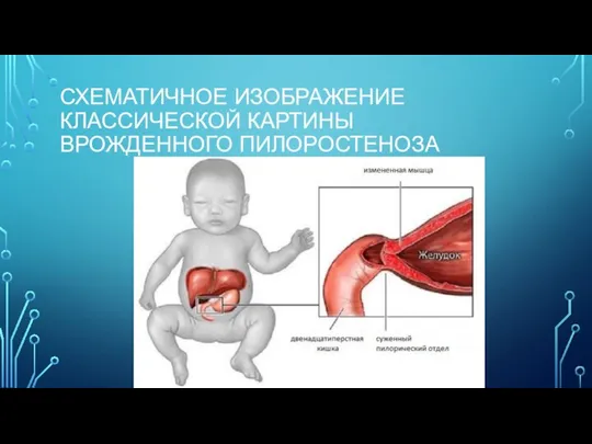 СХЕМАТИЧНОЕ ИЗОБРАЖЕНИЕ КЛАССИЧЕСКОЙ КАРТИНЫ ВРОЖДЕННОГО ПИЛОРОСТЕНОЗА