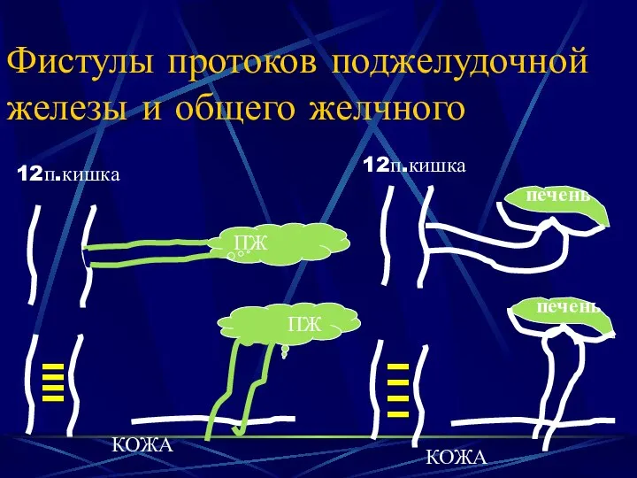 Фистулы протоков поджелудочной железы и общего желчного ПЖ ПЖ КОЖА 12п.кишка 12п.кишка печень КОЖА печень