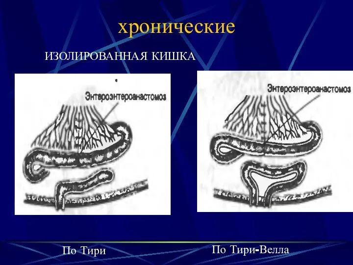 хронические ИЗОЛИРОВАННАЯ КИШКА По Тири По Тири-Велла