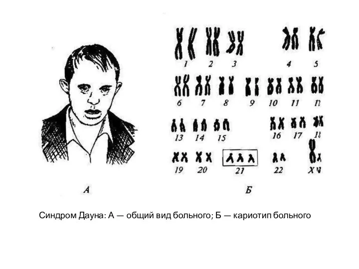 Синдром Дауна: А — общий вид больного; Б — кариотип больного