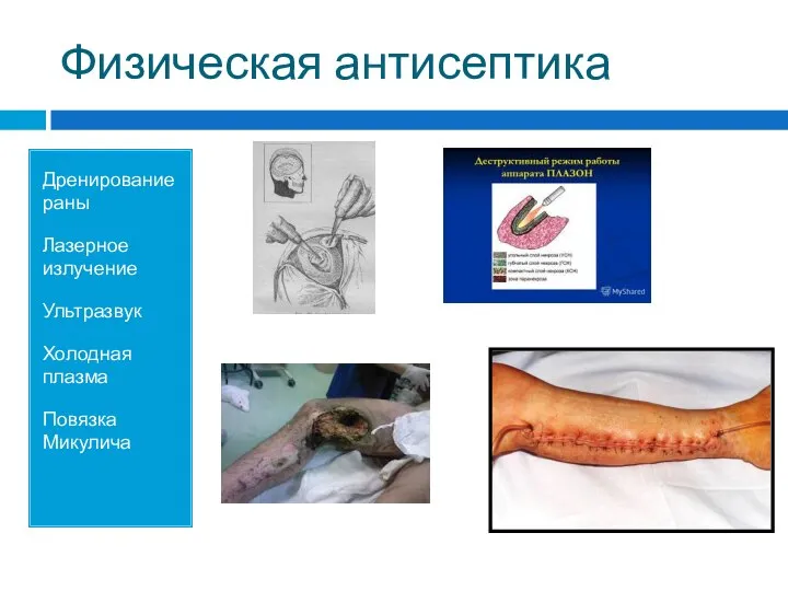 Физическая антисептика Дренирование раны Лазерное излучение Ультразвук Холодная плазма Повязка Микулича