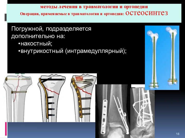 методы лечения в травматологии и ортопедии Операции, применяемые в травматологии и