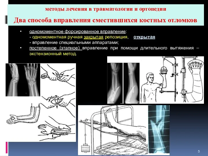 методы лечения в травматологии и ортопедии Два способа вправления сместившихся костных