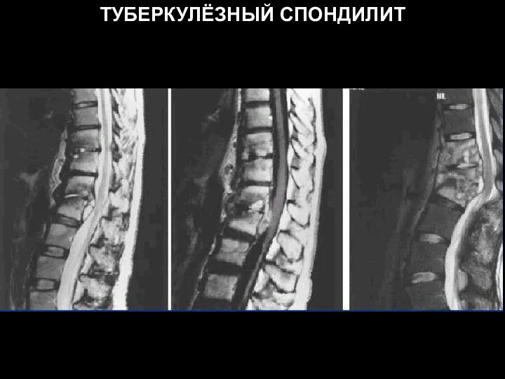 ТУБЕРКУЛЁЗНЫЙ СПОНДИЛИТ