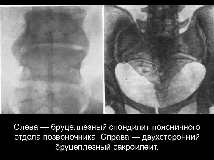 Слева — бруцеллезный спондилит поясничного отдела позвоночника. Справа — двухсторонний бруцеллезный сакроилеит.