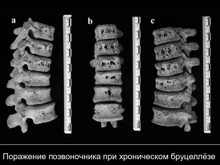 Поражение позвоночника при хроническом бруцеллёзе