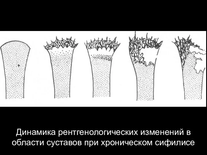 Динамика рентгенологических изменений в области суставов при хроническом сифилисе