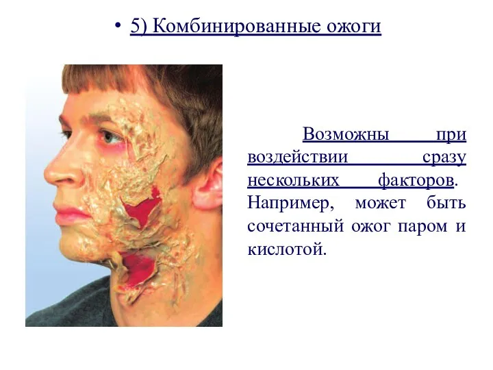 5) Комбинированные ожоги Возможны при воздействии сразу нескольких факторов. Например, может