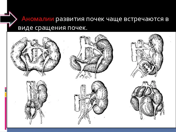 Аномалии развития почек чаще встречаются в виде сращения почек.