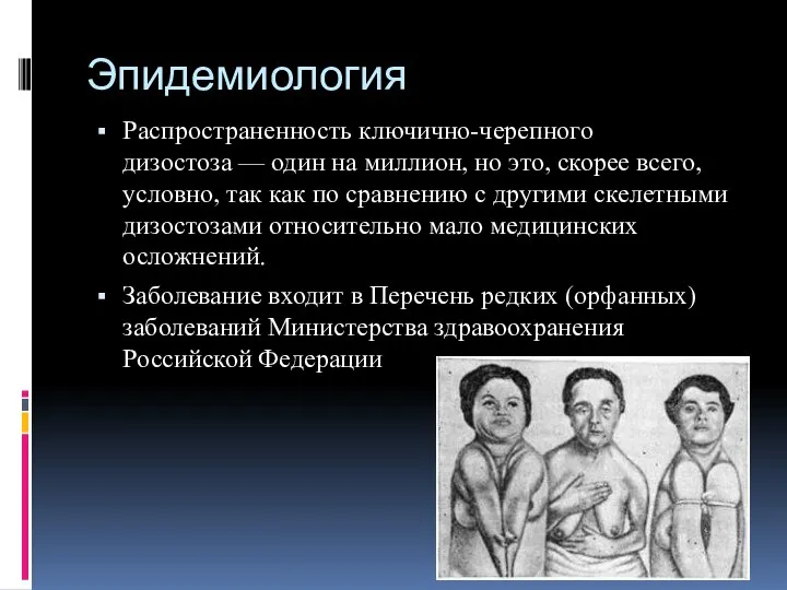 Эпидемиология Распространенность ключично-черепного дизостоза — один на миллион, но это, скорее