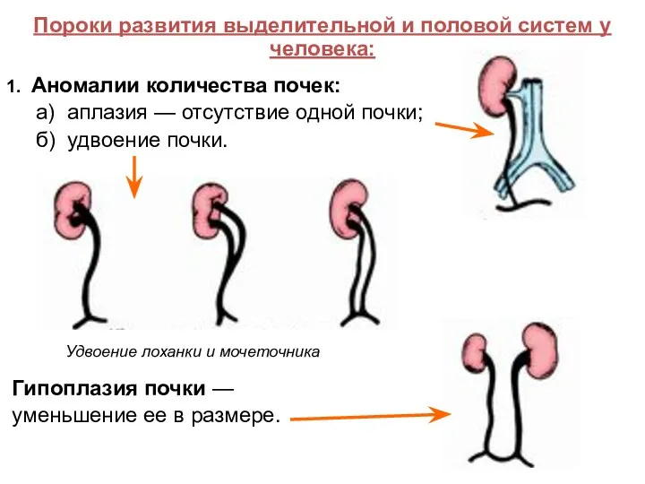 Пороки развития выделительной и половой систем у человека: 1. Аномалии количества