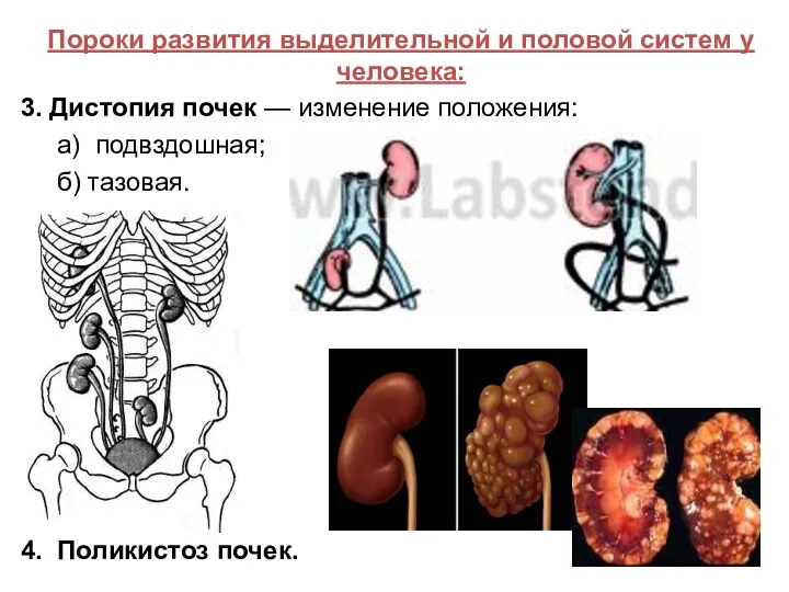 Пороки развития выделительной и половой систем у человека: 3. Дистопия почек