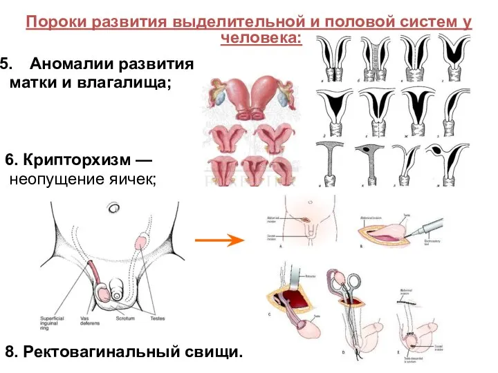 Пороки развития выделительной и половой систем у человека: Аномалии развития матки