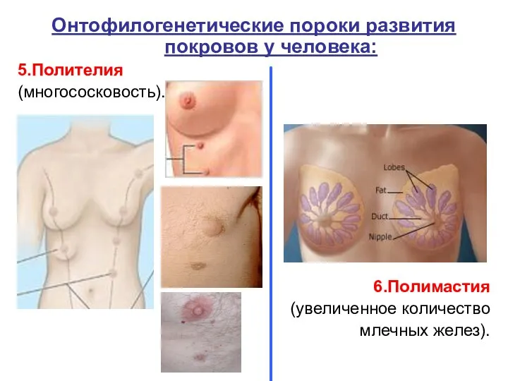 Онтофилогенетические пороки развития покровов у человека: 5.Полителия (многососковость). 6.Полимастия (увеличенное количество млечных желез).