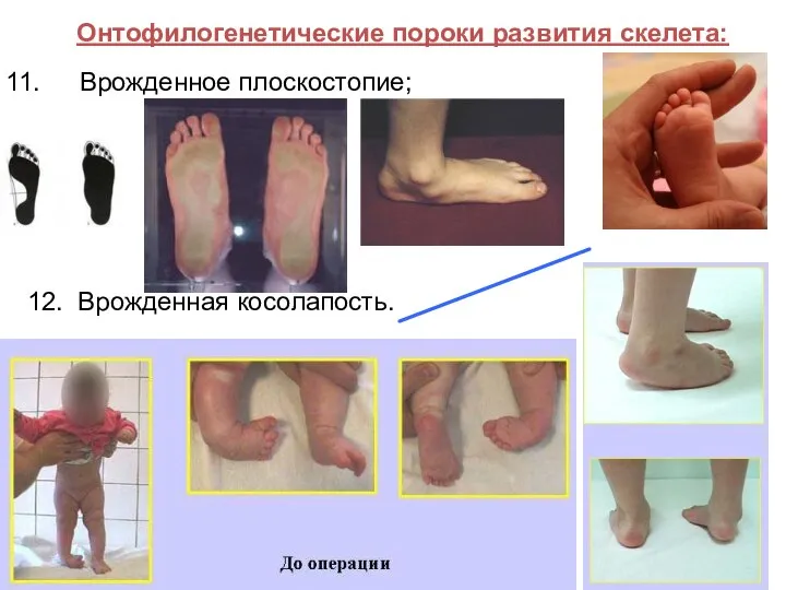 Онтофилогенетические пороки развития скелета: Врожденное плоскостопие; 12. Врожденная косолапость.